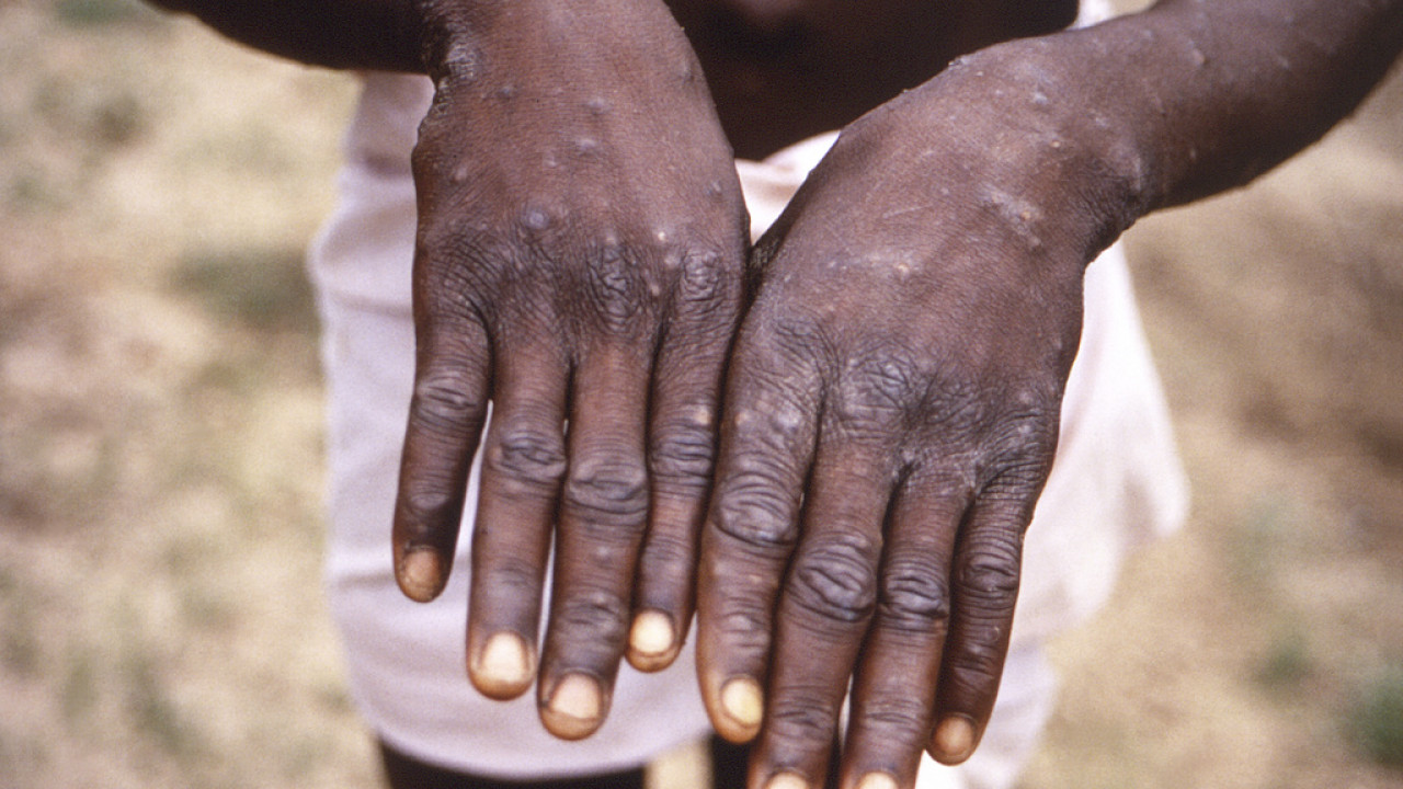 Ευλογιά των πιθήκων – mpox: Η Ταϊλάνδη επιβεβαίωσε ότι κατέγραψε το 1ο κρούσμα στην Ασία του στελέχους που ευθύνεται για την τρέχουσα επιδημία στην Αφρική Ευλογιά των πιθήκων – mpox: Η Ταϊλάνδη επιβεβαίωσε ότι κατέγραψε το 1ο κρούσμα στην Ασία του στελέχους που ευθύνεται για την τρέχουσα επιδημία στην Αφρική