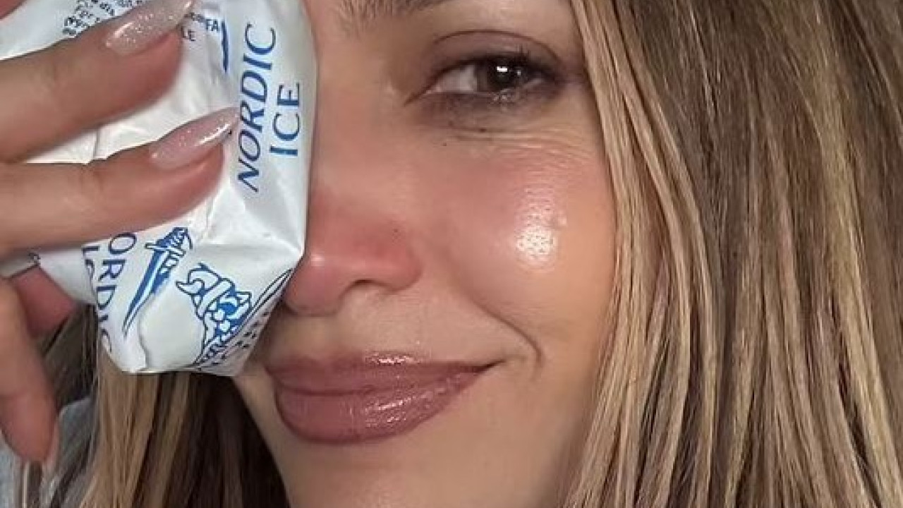 Jennifer Lopez: Εμφανίστηκε στο Instagram μελανιασμένη και πρησμένη