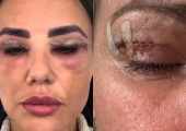 Γυναίκα μετά από βλεφαροπλαστική - Φωτογραφία από βίντεο του BBC