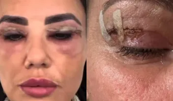 Γυναίκα μετά από βλεφαροπλαστική - Φωτογραφία από βίντεο του BBC
