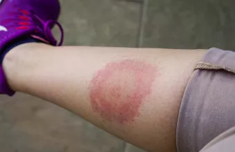 Νόσος Lyme από τσιμπούρια 