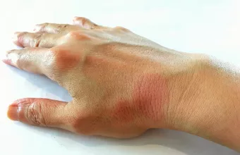 Κυτταρική ανοσοθεραπεία πέτυχε πλήρη ύφεση του ερυθηματώδους λύκου