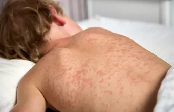 measles