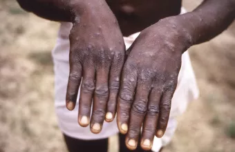 mpox 