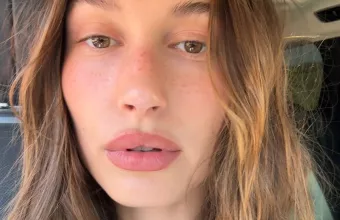 Hailey Bieber Δερματίτιδα Hailey Bieber Δερματίτιδα