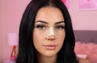 Μοντέλο πλαστική μύτης για...κληρονομικότητα