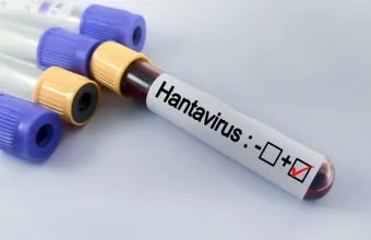 Δοκιμαστικός σωλήνας Hantavirus