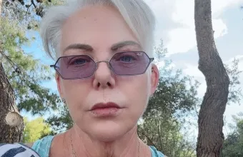 Νανά Παλαιτσάκη neck lift