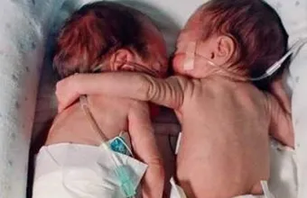 Καρκίνος μεταφέρθηκε από το ένα δίδυμο στο άλλο πριν από τη γέννηση - Τι έδειξε νέα μελέτη