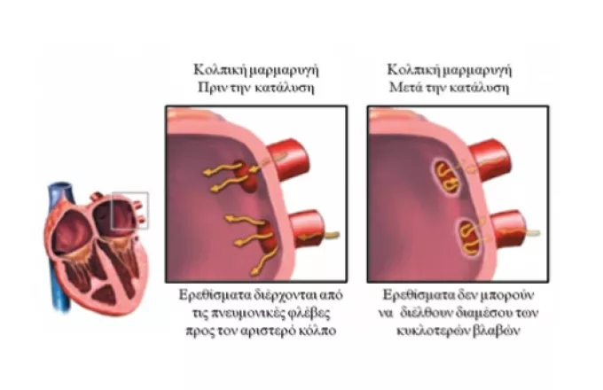 Επεμβατική αντιμετώπιση κολπικής μαρμαρυγής