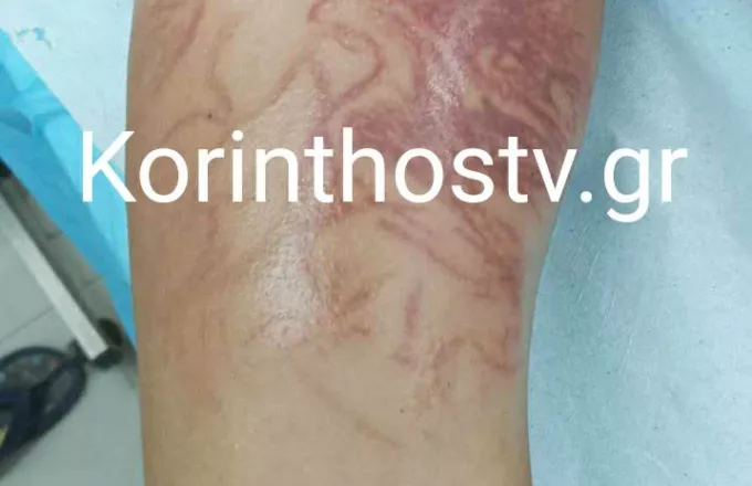 Κορινθία: Στο νοσοκομείο 9χρονος που δέχτηκε τσίμπημα απο θαλάσσια ανεμώνη