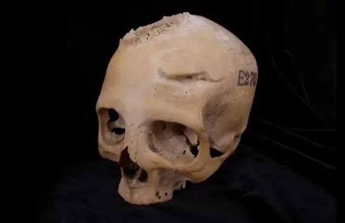 Αρχαία Αίγυπτος: Στοιχεία χειρουργικής αφαίρεσης όγκου σε κρανίο 4.000 ετών  | ΣΚΑΪ