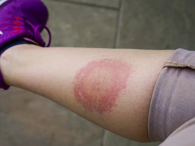 Νόσος Lyme από τσιμπούρια 