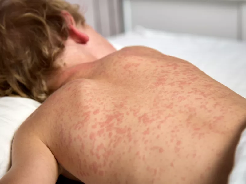 measles