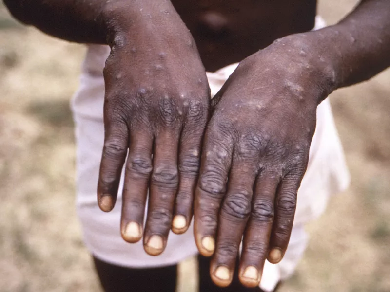 mpox 