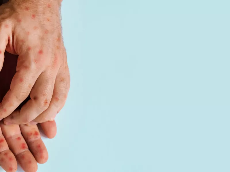 Μpox - ΠΟΥ: Συνεδριάζει η επιτροπή αντιμετώπισης κρίσεων για την ευλογιά των πιθήκων