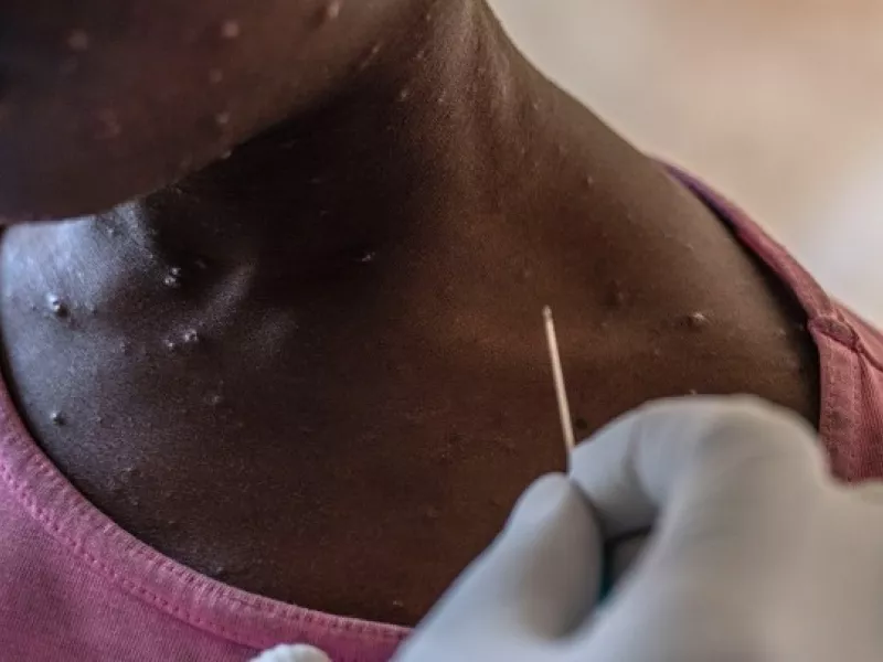 Κονγκό mpox